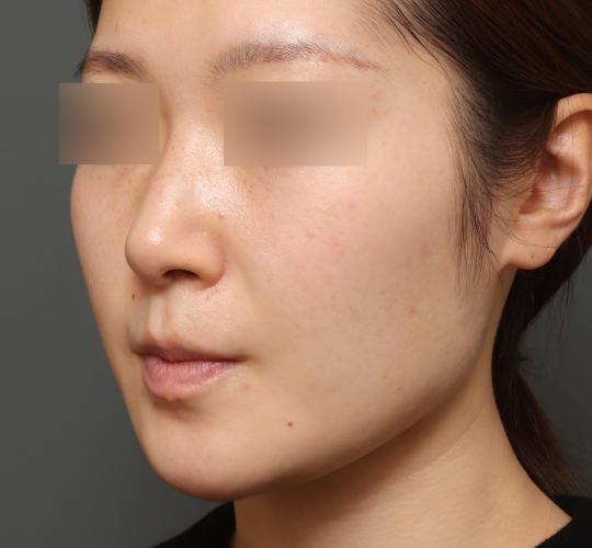 20代女性のボトックス(小顔) After 症例写真