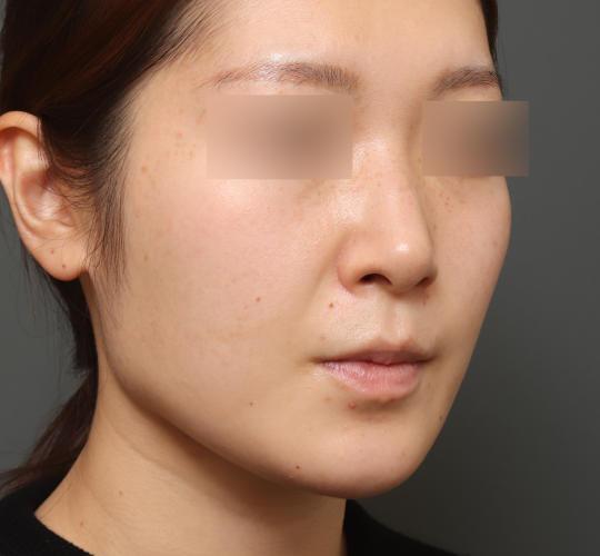 20代女性の顔の脂肪吸引  After 症例写真