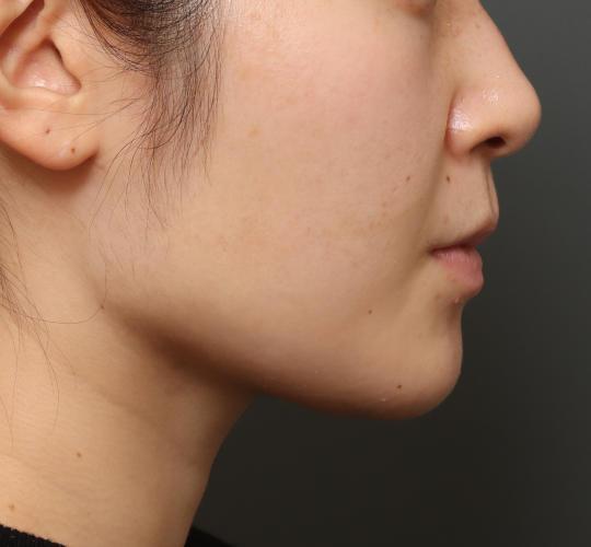 20代女性の顔の脂肪吸引  After 症例写真