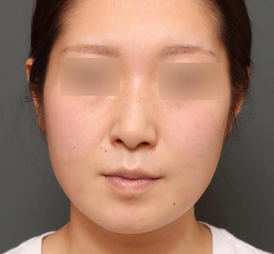 20代女性の顔の脂肪吸引  Before 症例写真
