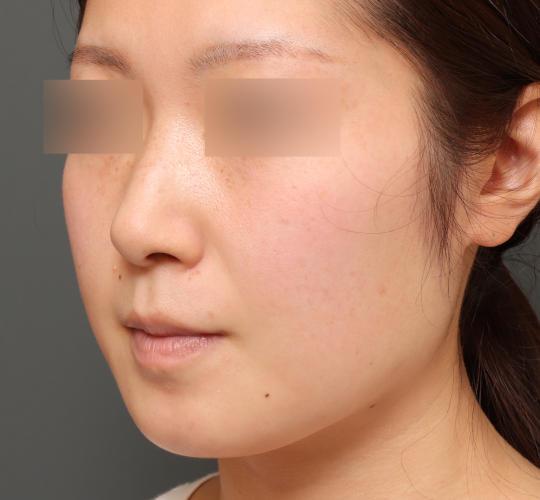 20代女性のボトックス(小顔) Before 症例写真