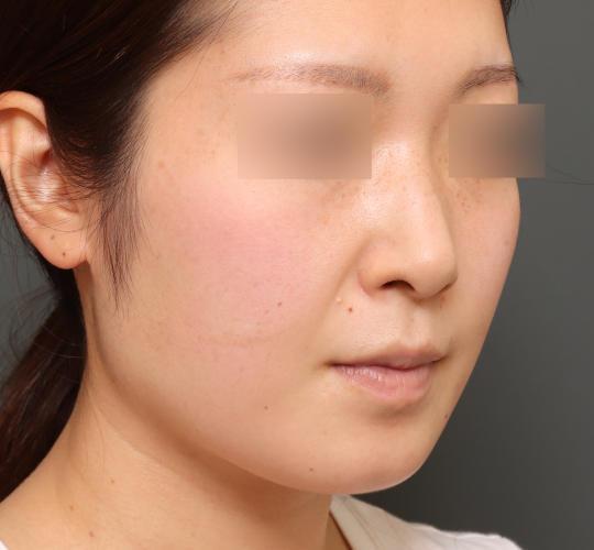 20代女性の顔の脂肪吸引  Before 症例写真