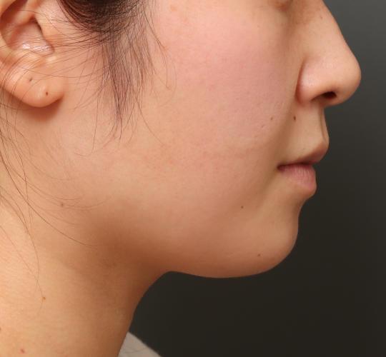 20代女性の顔の脂肪吸引  Before 症例写真