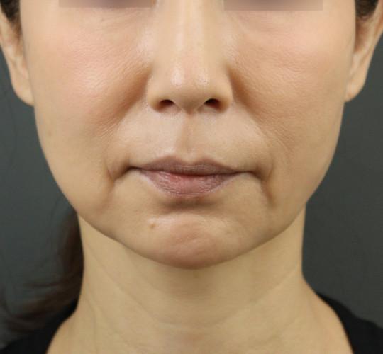 50代女性のVOVリフトプレミアム After 症例写真