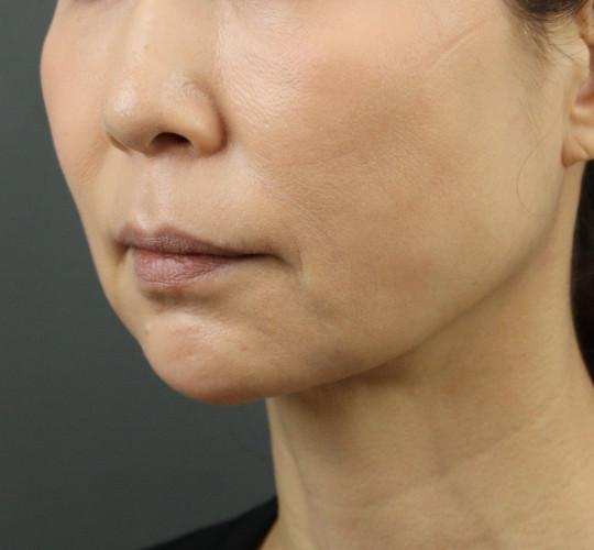50代女性のVOVリフトプレミアム After 症例写真