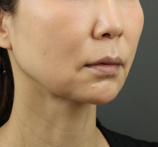 50代女性のVOVリフトプレミアム After 症例写真