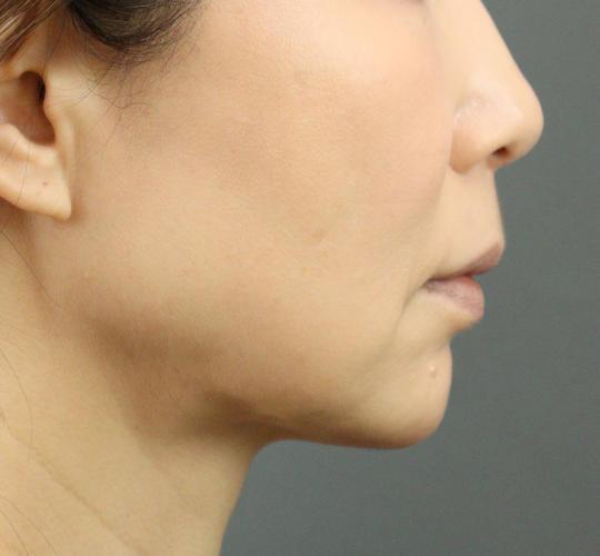 50代女性のVOVリフトプレミアム After 症例写真