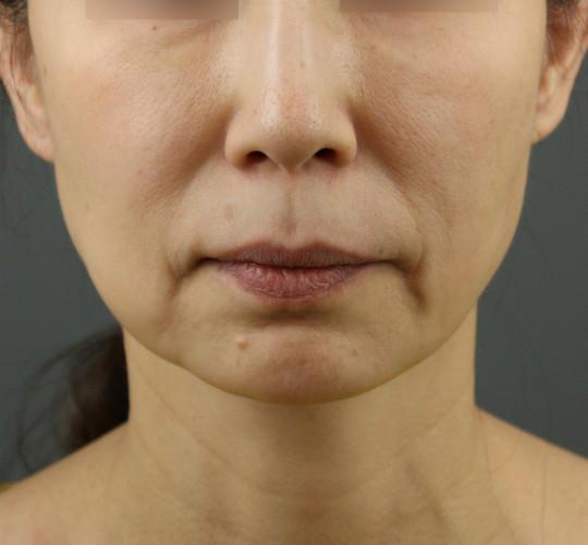 50代女性のVOVリフトプレミアム Before 症例写真