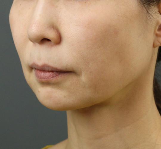 50代女性のVOVリフトプレミアム Before 症例写真