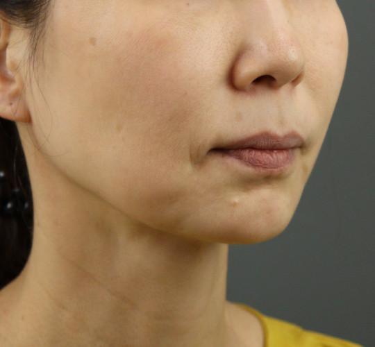 50代女性のVOVリフトプレミアム Before 症例写真