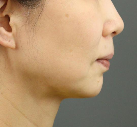 50代女性のVOVリフトプレミアム Before 症例写真