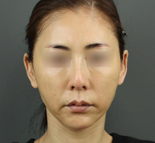 50代女性のVOVリフトプレミアム After 症例写真