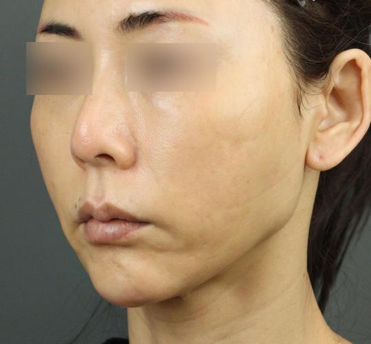 50代女性のVOVリフトプレミアム After 症例写真