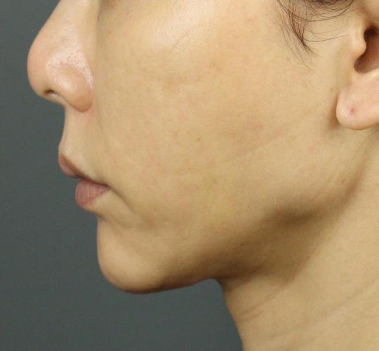 50代女性のVOVリフトプレミアム After 症例写真