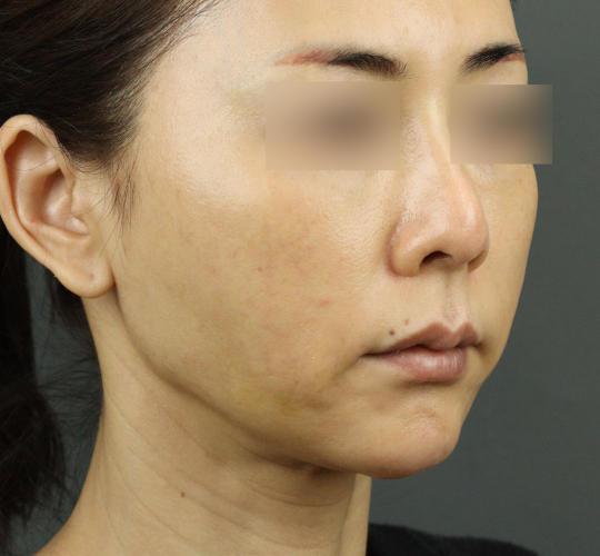 50代女性のVOVリフトプレミアム After 症例写真