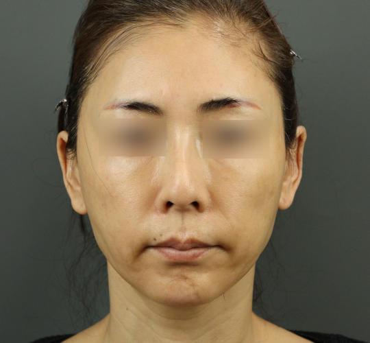 50代女性のVOVリフトプレミアム Before 症例写真