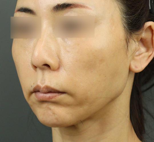 50代女性のVOVリフトプレミアム Before 症例写真