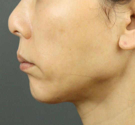 50代女性のVOVリフトプレミアム Before 症例写真