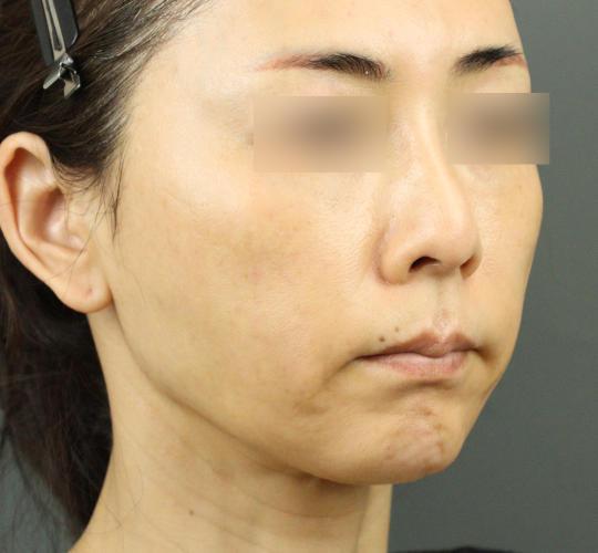 50代女性のVOVリフトプレミアム Before 症例写真