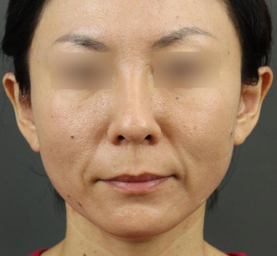 40代女性のVOVリフトプレミアム After 症例写真