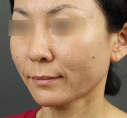 40代女性のVOVリフトプレミアム After 症例写真