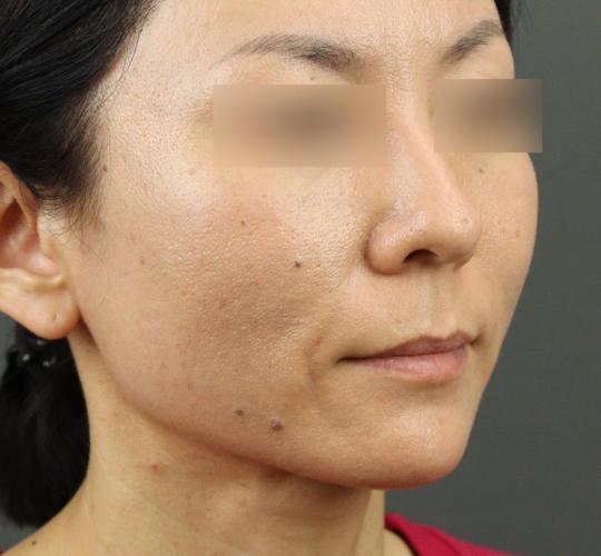 40代女性のVOVリフトプレミアム After 症例写真