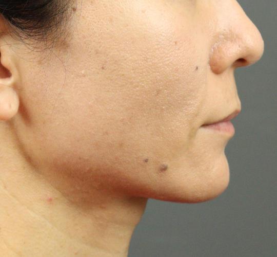 40代女性のVOVリフトプレミアム After 症例写真