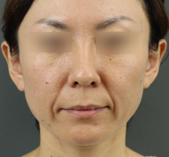 40代女性のVOVリフトプレミアム Before 症例写真