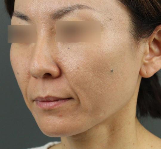 40代女性のVOVリフトプレミアム Before 症例写真