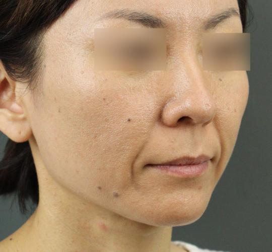 40代女性のVOVリフトプレミアム Before 症例写真