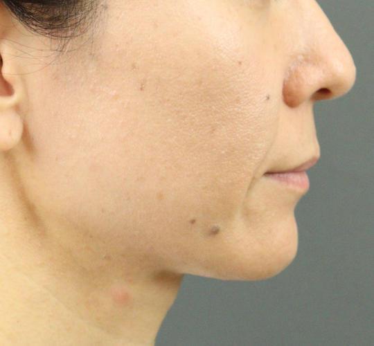 40代女性のVOVリフトプレミアム Before 症例写真