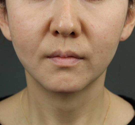 40代女性のVOVリフトプレミアム After 症例写真