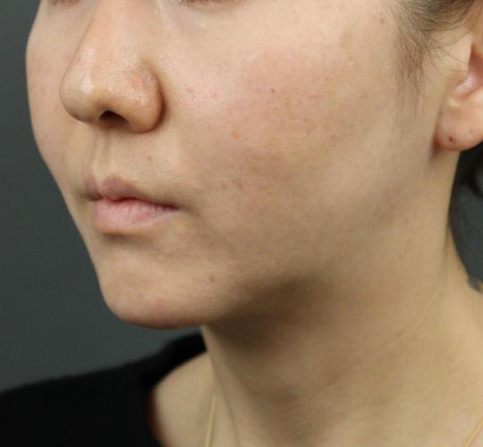 40代女性のVOVリフトプレミアム After 症例写真