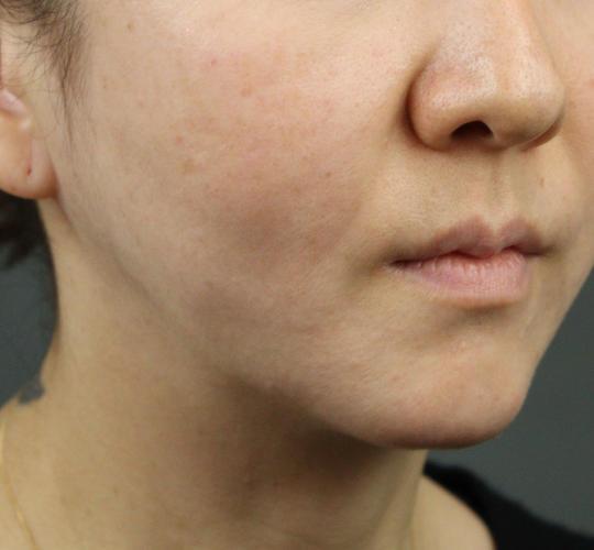 40代女性のVOVリフトプレミアム After 症例写真