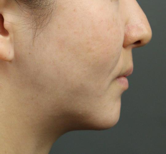 40代女性のVOVリフトプレミアム After 症例写真