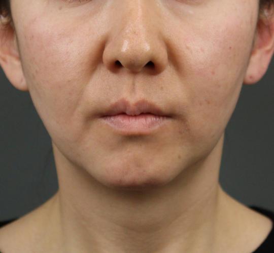 40代女性のVOVリフトプレミアム Before 症例写真