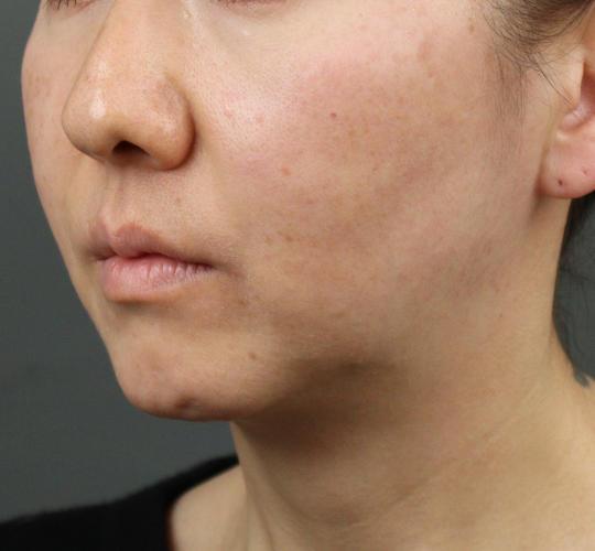 40代女性のVOVリフトプレミアム Before 症例写真