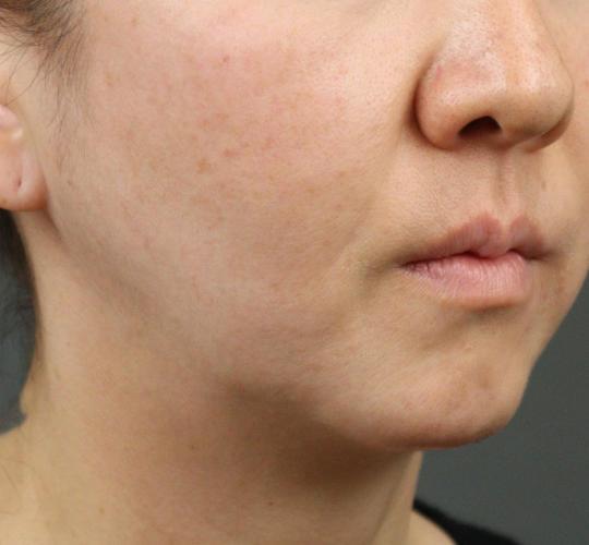 40代女性のVOVリフトプレミアム Before 症例写真