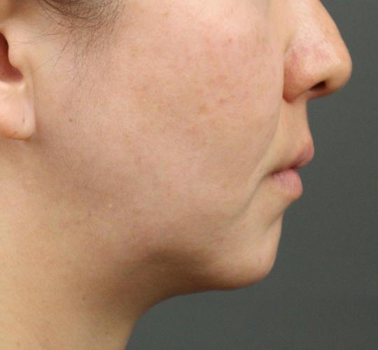 40代女性のVOVリフトプレミアム Before 症例写真