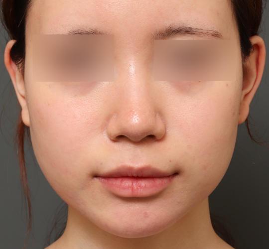 10代女性の人中短縮(リップリフト) Before 症例写真