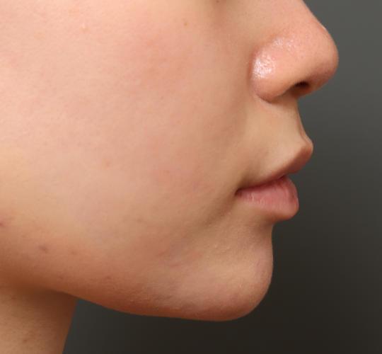 10代女性の鼻翼縮小(小鼻縮小) Before 症例写真