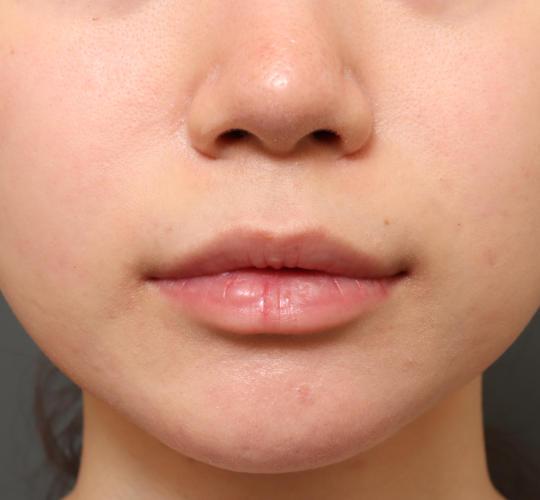 10代女性の鼻翼縮小(小鼻縮小) Before 症例写真