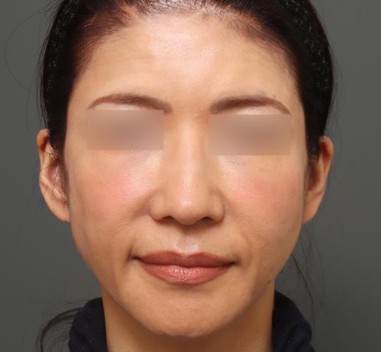 50代女性のヒアルロン酸注射  After 症例写真