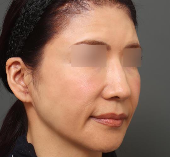 50代女性のヒアルロン酸注射  After 症例写真