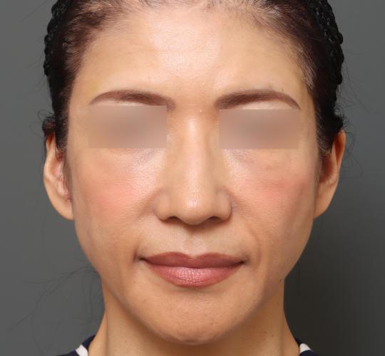 50代女性のヒアルロン酸注射  Before 症例写真