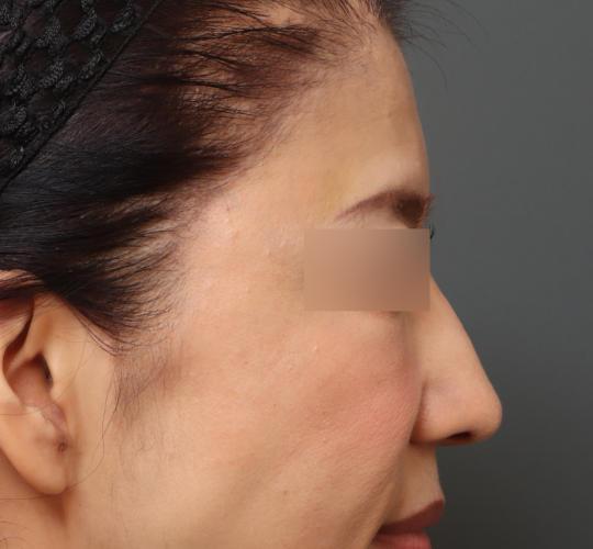 50代女性のヒアルロン酸注射  Before 症例写真