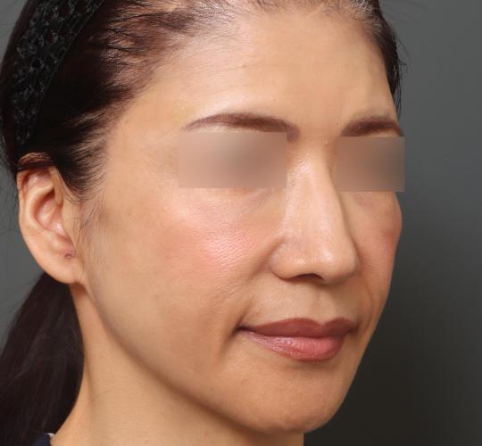 50代女性のヒアルロン酸注射  Before 症例写真