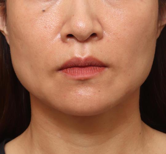 40代女性のヒアルロン酸注射（ほうれい線） After 症例写真