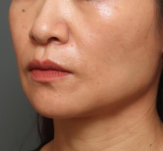 40代女性のヒアルロン酸注射（ほうれい線） After 症例写真