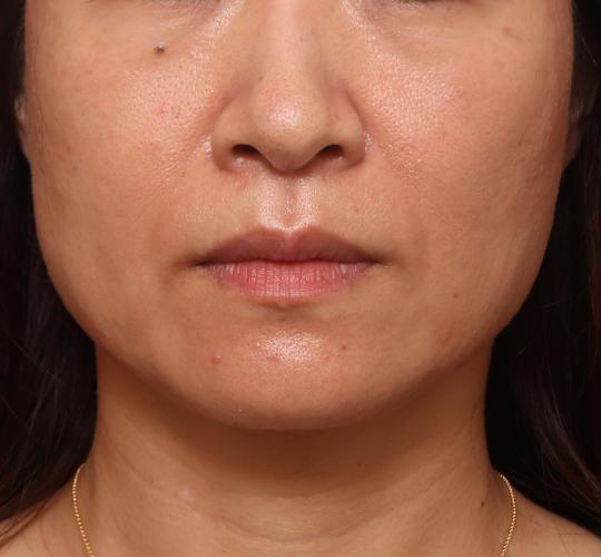 40代女性のヒアルロン酸注射（ほうれい線） Before 症例写真